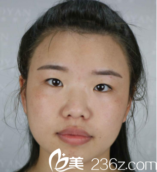 眼綜合+鼻綜合術(shù)手術(shù)前