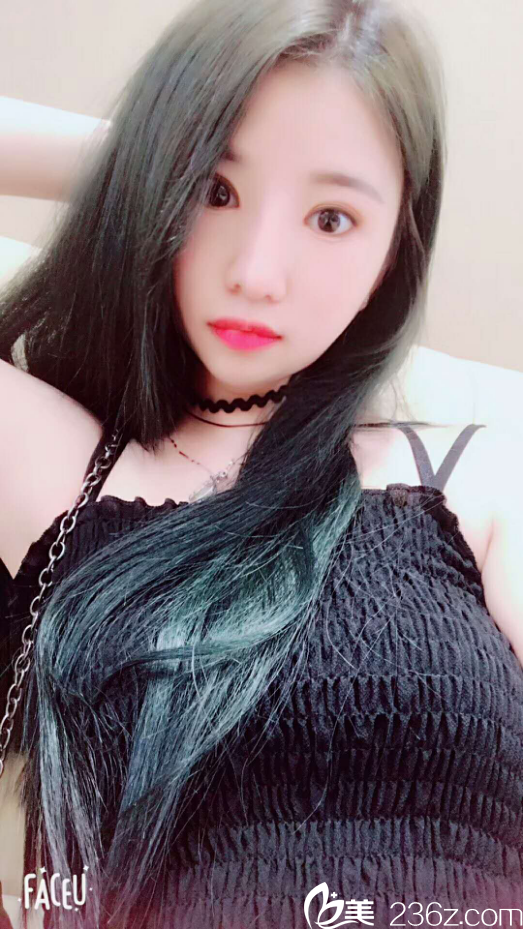 寧波童顏眼綜合鼻綜合案例