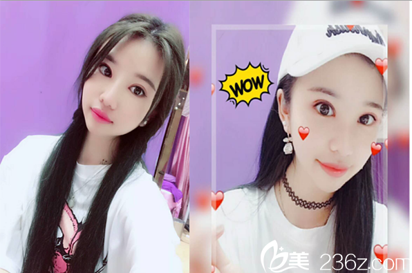 雙眼皮鼻綜合案例