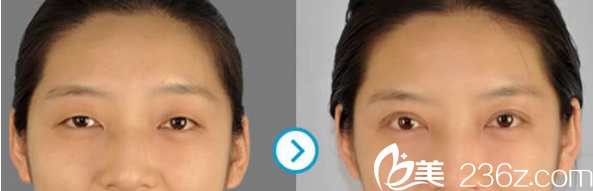 韓國ROCOCO雙眼皮案例 韓國ROCOCO雙眼皮案例