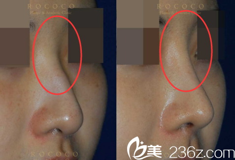 韓國ROCOCO隆鼻案例 韓國ROCOCO隆鼻案例