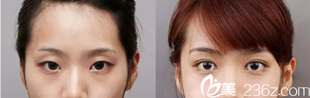 韓國(guó)ROCOCO醫(yī)院金相虎切開(kāi)雙眼皮案例 韓國(guó)ROCOCO醫(yī)院金相虎切開(kāi)雙眼皮案例