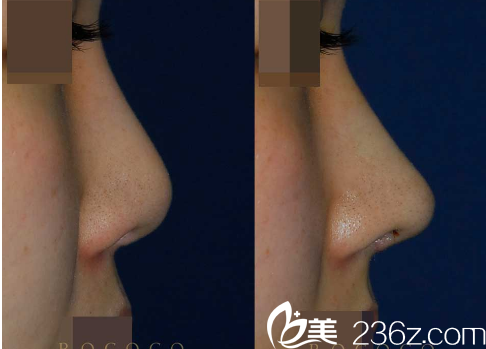 韓國(guó)ROCOCO醫(yī)院金相虎鼻綜合案例 韓國(guó)ROCOCO醫(yī)院金相虎鼻綜合案例