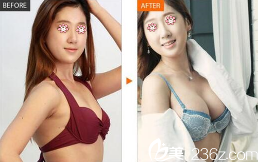 尹盛浩院長胸部整形案例