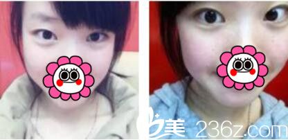 韓國姜元景整形外科姜元景雙眼皮真人案例術前照 韓國姜元景整形外科姜元景雙眼皮真人案例術前照