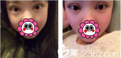 韓國姜元景整形外科姜元景雙眼皮真人案例術后第三天 韓國姜元景整形外科姜元景雙眼皮真人案例術后第三天