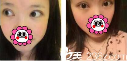 韓國姜元景整形外科姜元景雙眼皮真人案例術后第七天 韓國姜元景整形外科姜元景雙眼皮真人案例術后第七天