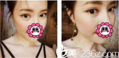 韓國姜元景整形外科姜元景雙眼皮真人案例術后二十一天 韓國姜元景整形外科姜元景雙眼皮真人案例術后二十一天