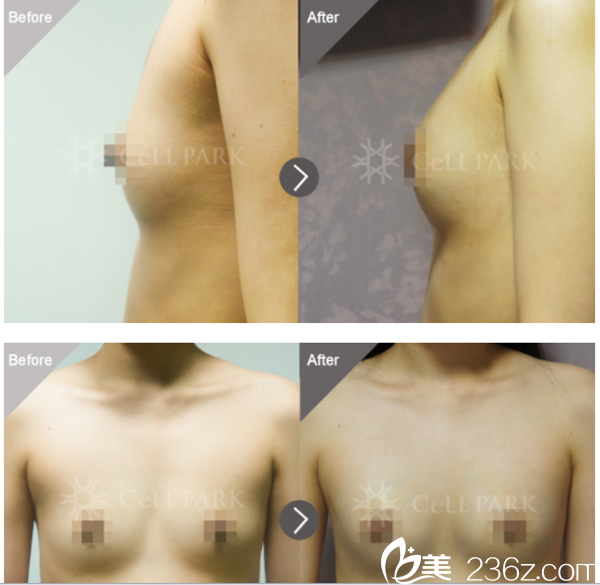自體脂肪豐胸.png