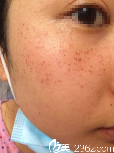 剛做完皮秒祛斑面部有些發(fā)紅