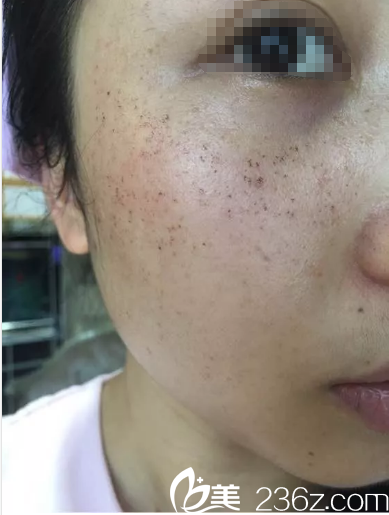 皮秒祛斑術(shù)后三天開始掉痂