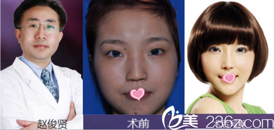 北京美萊趙峻賢雙眼皮<span style=