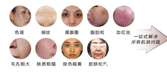 光子嫩膚治療的范圍有痘印 收縮毛孔 光子嫩膚治療的范圍有痘印 收縮毛孔