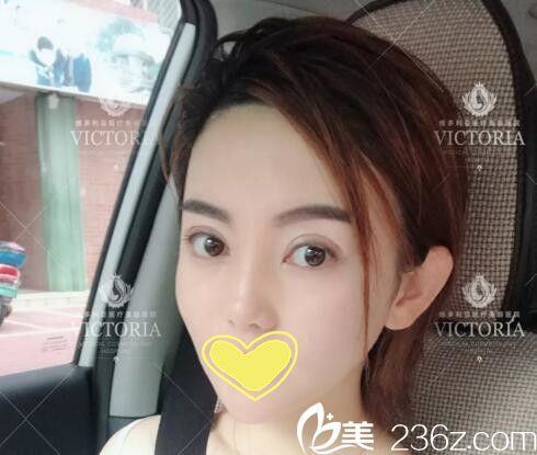 美眼綜合術(shù)后第十天<span style= 美眼綜合術(shù)后第十天<span style=