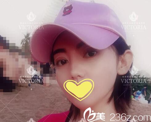 術(shù)后樣子 術(shù)后樣子