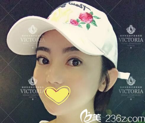 三亞維多利亞真人案例：自從段亦棋醫(yī)生給我做了雙眼皮后整個(gè)人都變得自信了