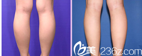 韓國Ree&Ahn Clinic醫(yī)院注射瘦腿案例 韓國Ree&Ahn Clinic醫(yī)院注射瘦腿案例