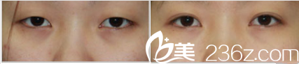 韓國Ree&Ahn Clinic醫(yī)院雙眼皮案例 韓國Ree&Ahn Clinic醫(yī)院雙眼皮案例