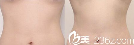 韓國Ree&Ahn Clinic醫(yī)院腹部吸脂案例 韓國Ree&Ahn Clinic醫(yī)院腹部吸脂案例