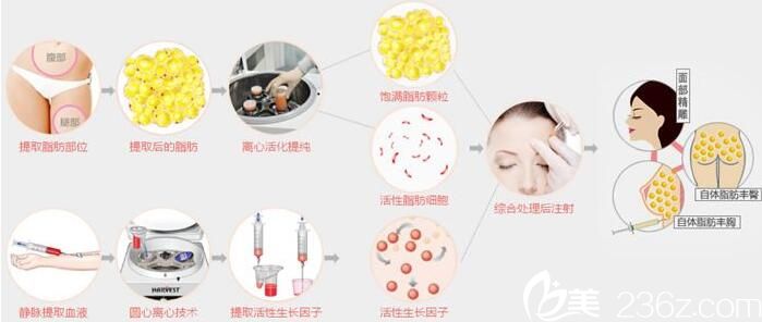 韓國(guó)金世永整形外科自體脂肪移植圖