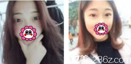 韓國(guó)金世永整形外科金世永雙眼皮真人案例術(shù)前照 韓國(guó)金世永整形外科金世永雙眼皮真人案例術(shù)前照