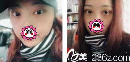 韓國(guó)金世永整形外科金世永雙眼皮真人案例術(shù)后第三天 韓國(guó)金世永整形外科金世永雙眼皮真人案例術(shù)后第三天