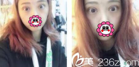 韓國(guó)金世永整形外科金世永雙眼皮真人案例術(shù)后第七天 韓國(guó)金世永整形外科金世永雙眼皮真人案例術(shù)后第七天