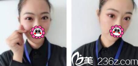 韓國(guó)金世永整形外科金世永雙眼皮真人案例術(shù)后二十一天 韓國(guó)金世永整形外科金世永雙眼皮真人案例術(shù)后二十一天