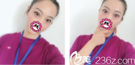 趁著五一休假去韓國(guó)金世永做了韓式雙眼皮，現(xiàn)在恢復(fù)的特別自然