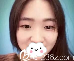 在長沙希美做雙眼皮術(shù)前照 在長沙希美做雙眼皮術(shù)前照