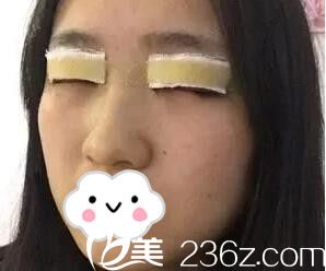 長沙希美肖陽做的雙眼皮+開眼角術(shù)當天照 長沙希美肖陽做的雙眼皮+開眼角術(shù)當天照