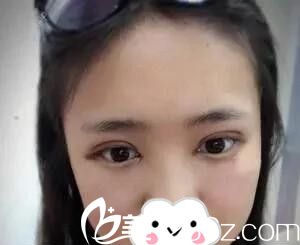 肖陽做的雙眼皮開眼角術(shù)后第三天 肖陽做的雙眼皮開眼角術(shù)后第三天