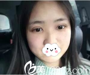 在長沙希美做雙眼皮開眼角術(shù)后半個月效果 在長沙希美做雙眼皮開眼角術(shù)后半個月效果