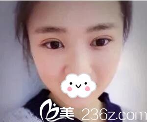 肖陽院長做的雙眼皮開眼角術(shù)后1個月時效果 肖陽院長做的雙眼皮開眼角術(shù)后1個月時效果