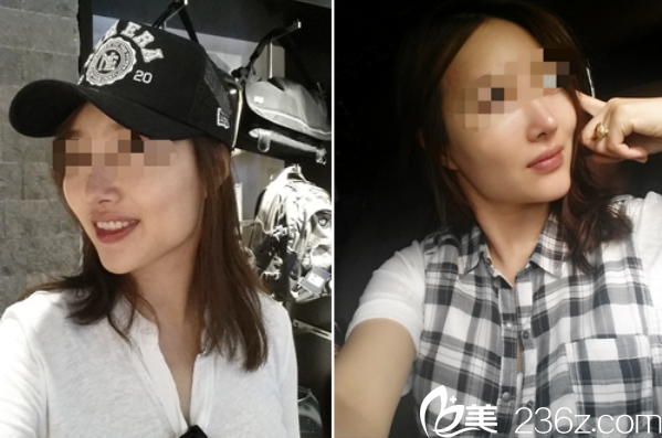 韓國(guó)愛寶live四方臉改善手術(shù)前后對(duì)比 韓國(guó)愛寶live四方臉改善手術(shù)前后對(duì)比