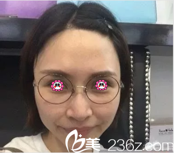 在北京壹加壹做埋線提升前樣子 在北京壹加壹做埋線提升前樣子