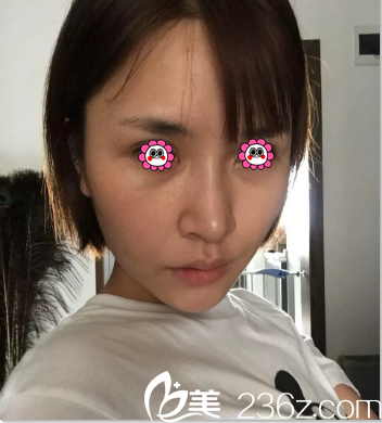 在北京壹加壹找田瑩做埋線提升第7天效果 在北京壹加壹找田瑩做埋線提升第7天效果