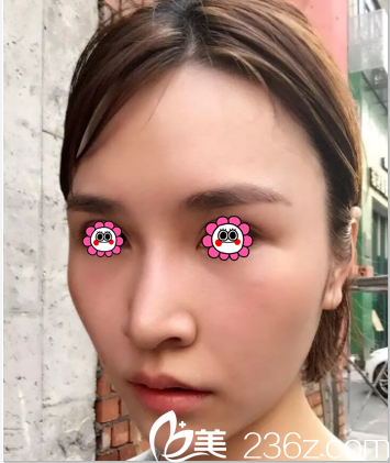 北京壹加壹田瑩意大利悅升提拉+童顏鈴鐺線半月效果 北京壹加壹田瑩意大利悅升提拉+童顏鈴鐺線半月效果