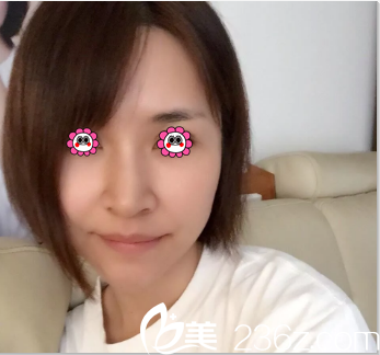 田瑩意大利悅升提拉+童顏鈴鐺線案例 田瑩意大利悅升提拉+童顏鈴鐺線案例