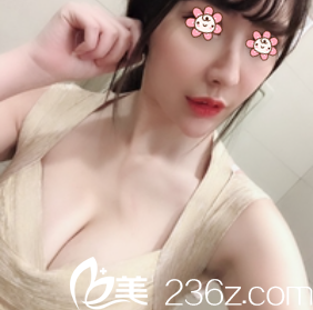 韓國POINT整形外科假體隆胸術后23天 韓國POINT整形外科假體隆胸術后23天