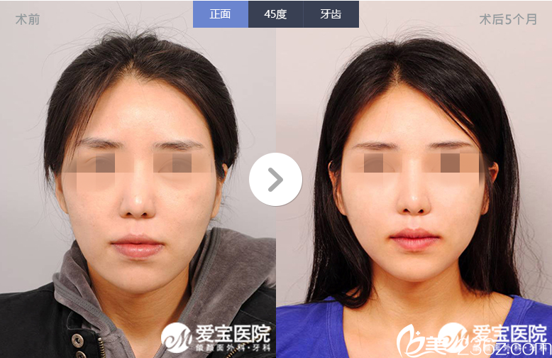 韓國愛寶整形醫(yī)院做輪廓失敗修復(fù)案例 韓國愛寶整形醫(yī)院做輪廓失敗修復(fù)案例