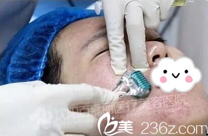 百嘉麗微針祛痘術(shù)過程中