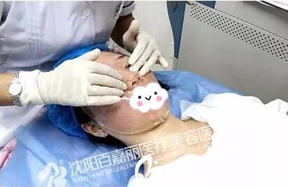 微針祛痘術(shù)后敷面膜