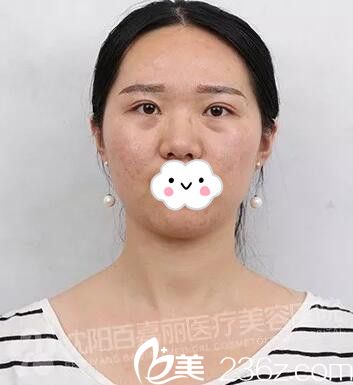 在百嘉麗做微針祛痘術(shù)后3天