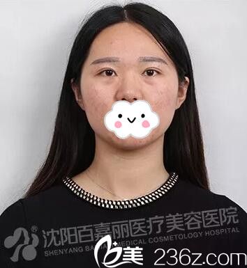 在沈陽百嘉麗做微針祛痘術(shù)后半個(gè)月