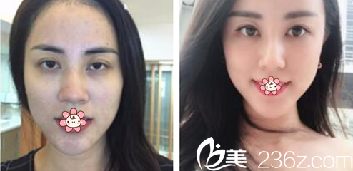 周鄧霆主任面部線雕案例 周鄧霆主任面部線雕案例