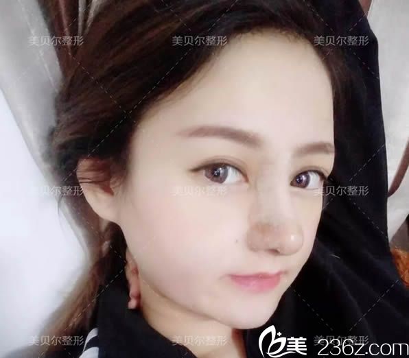 綜合隆鼻術(shù)后第5天的樣子 綜合隆鼻術(shù)后第5天的樣子