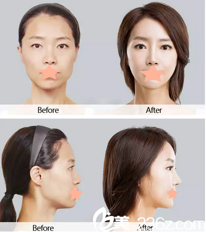 李信奎鼻部整形真人案例