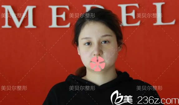 本人做綜合隆鼻術(shù)前照 本人做綜合隆鼻術(shù)前照