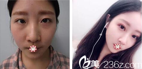 金永燦院長(zhǎng)雙眼皮修復(fù)案例 金永燦院長(zhǎng)雙眼皮修復(fù)案例